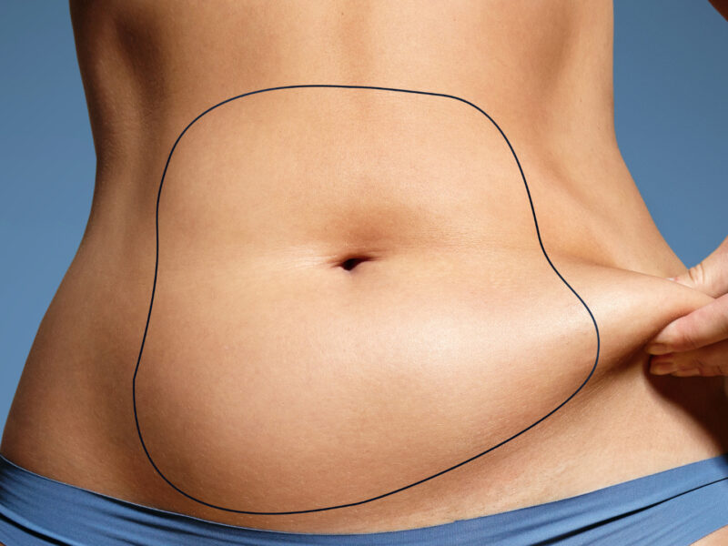 Combien coûte une abdominoplastie avec liposuccion ventre en Tunisie ? Tout ce que vous devez savoir