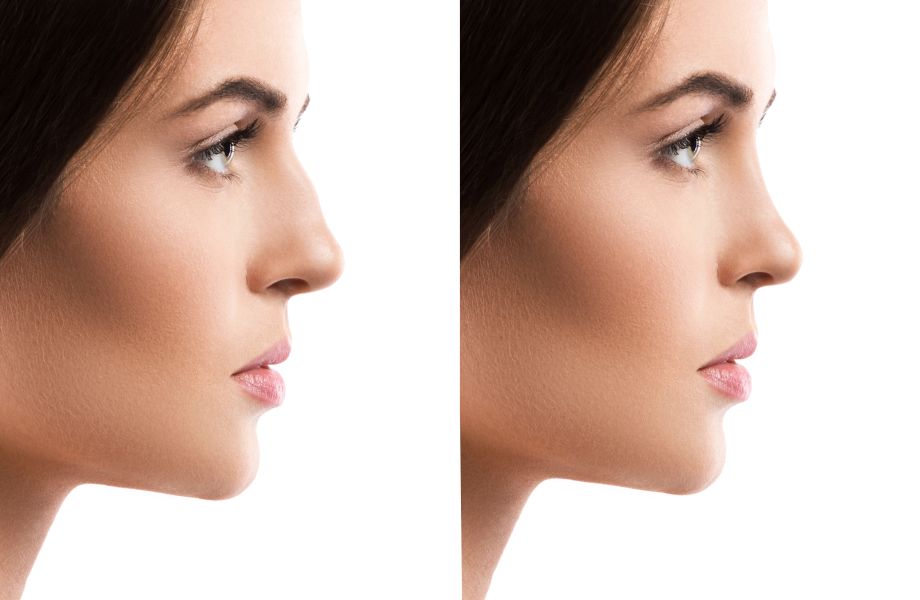 rhinoplastie