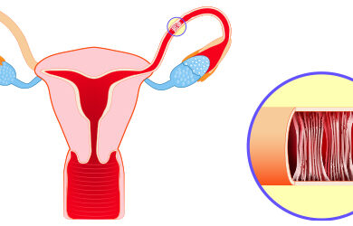 Obstruction des trompes de Fallope : quelle solution ?