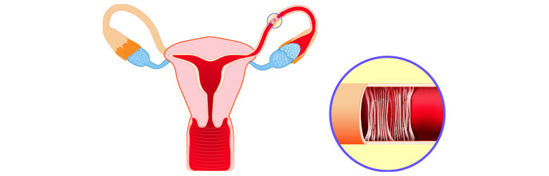 Obstruction des trompes de Fallope : quelle solution ?